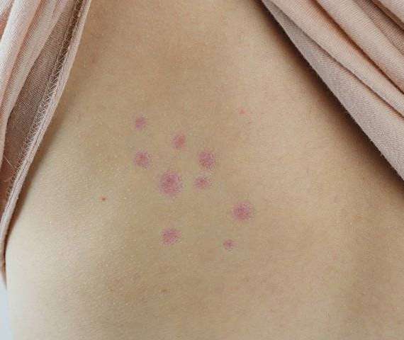Bed bug bites on skin
