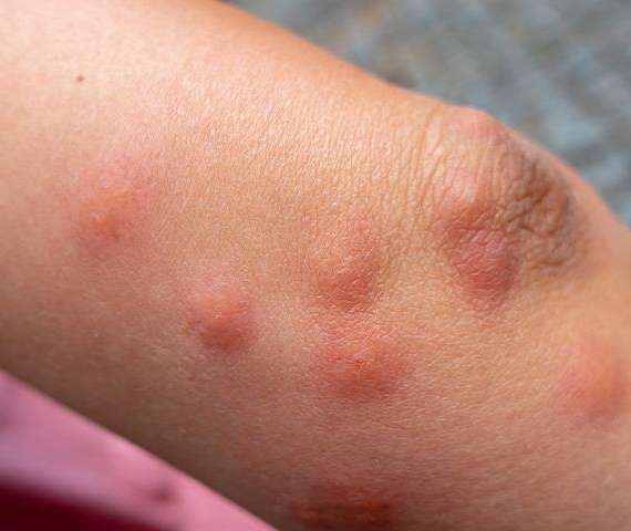 Bug Bites on a human arm
